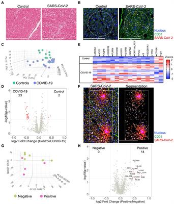 Spatial transcriptomic profiling of coronary endothelial cells in SARS-CoV-2 myocarditis